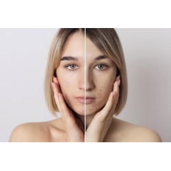 Pelle-senza-imperfezioni-acne-brufoli
