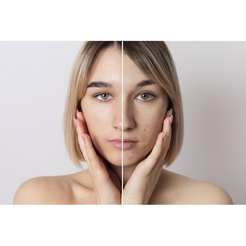 Pelle-senza-imperfezioni-acne-brufoli